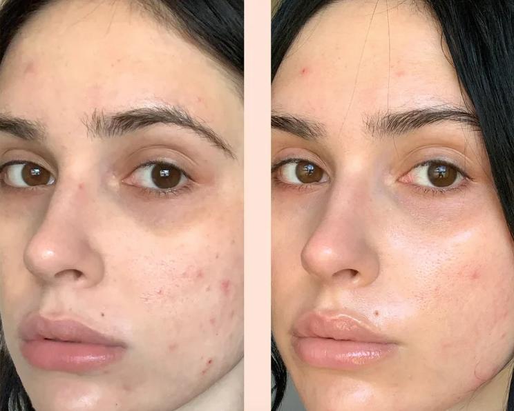 Expigment 2% Melasma Meloan Hyperpigmentation Skin-Bleaching