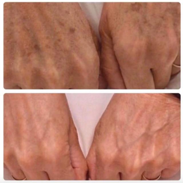Expigment 2% Melasma Meloan Hyperpigmentation Skin-Bleaching