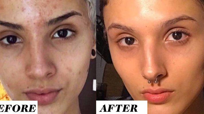 Acnelyse TRETINOIN 0.025% - Stage 1