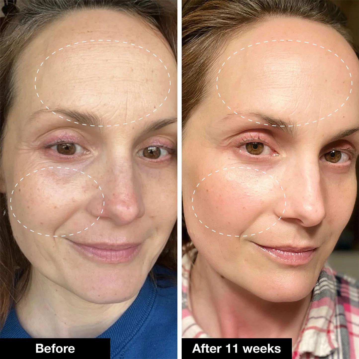 Acnelyse TRETINOIN 0.025% - Stage 1