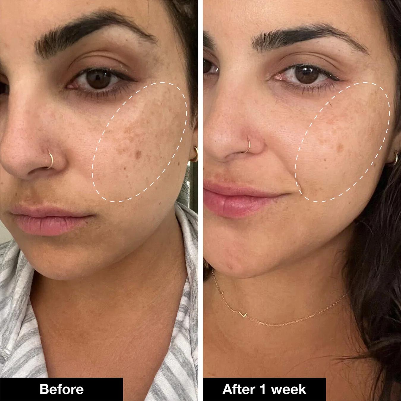 Acnelyse TRETINOIN 0.025% - Stage 1